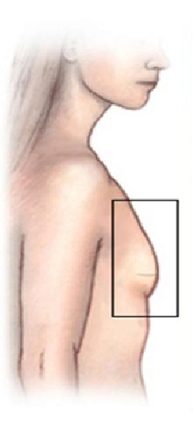 breast augmentation abroad